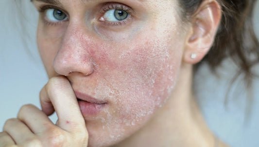 What Causes Dry Patches on Your Face? [A Comprehensive Guide]